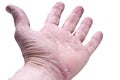 Psoriasis, skin disease