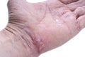 Psoriasis, skin disease