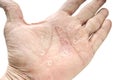 Psoriasis, skin disease