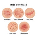 Psoriasis skin disease, types of derma problem
