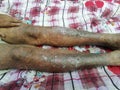 Psoriasis symptoms on lower limb