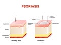 Psoriasis