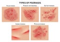 Psoriasis types. Skin hives, derma diseases. Closeup medical vector illustration