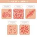 Psoriasis types. Skin problems close up medical illustrations vector set