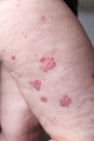 Psoriasis vulgaris is an autoimmune disease that affects the skin, detail photography for mainly medical magazines. Atopic dermati