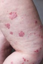 Psoriasis vulgaris is an autoimmune disease that affects the skin, detail photography for mainly medical magazines. Atopic dermati