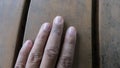 Psoriasis vulgaris, fungus, eczema on finger. rash, dermatological problem on dry skin Royalty Free Stock Photo
