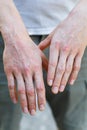 Psoriasis vulgaris on the mans hands with plaque, rash and patches on skin. Autoimmune genetic disease. Close up view. Vertical ph