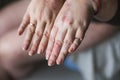 Psoriasis vulgaris on the womans hands with plaque, rash and patches on skin, isolated on white background. Autoimmune