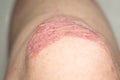 Psoriatic plaque on the skin of the knee. Close-up. Skin problems. Skin diseases.Soft focus Royalty Free Stock Photo