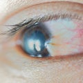 Pterygium Royalty Free Stock Photo