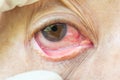 Pterygium in eye Royalty Free Stock Photo