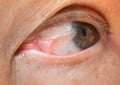 Pterygium in eye Royalty Free Stock Photo