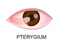 Pterygium growing onto the cornea. Conjunctival degeneration. Eye disease. Human organ of vision with pathology. Vector