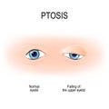 Ptosis is a drooping of the upper eyelid. lazy eye Royalty Free Stock Photo