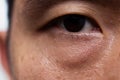 Ptosis Droopy eyelid in asian male oily skin type with dark eye bag Royalty Free Stock Photo