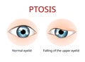 Ptosis of eyelid, eye sickness anatomy, eye sickness anatomy, vector Royalty Free Stock Photo