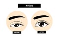 Ptosis of eyelid