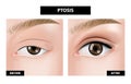 Ptosis of eyelid