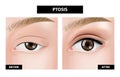 Ptosis of eyelid Royalty Free Stock Photo