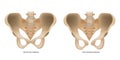 Pubic Symphysis Separation or SPD. Symphysis Pubis Dysfunction and Normal Pupic Symphysis.