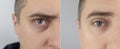 Before and after. Bags under eyes, hernias on the man face. Patient being examined by a plastic surgeon. Before and after