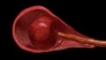 Pulling placenta out of uterus