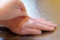 Testing for dehydration by pulling the skin up on the back of a hand.