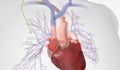 Pulmonary Artery Catheter Insertion into the Right Atrium