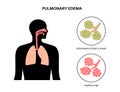 Pulmonary edema disease