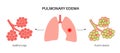 Pulmonary edema disease