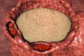 Pulmonary edema, close-up view of alveolus cross-section showing liquid in alveolus