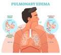 Pulmonary edema, lung problem vector illustration diagram Royalty Free Stock Photo