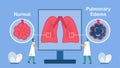 Pulmonary edema is shown good and bad alveoli. Other names is lung congestion, lung water, and pulmonary congestion. Ã Â¸ÂºBody