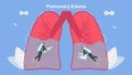 Pulmonary edema is symptom that lungs fill with fluid. Treatment and diagnostic. Body struggles to get enough oxygen until