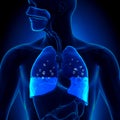 Pulmonary Edema - Water in Lungs