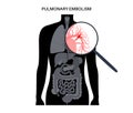 Pulmonary embolism disease Royalty Free Stock Photo