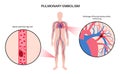 Pulmonary embolism disease Royalty Free Stock Photo