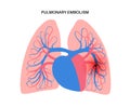 Pulmonary embolism disease