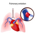 Pulmonary embolism. Human lungs and heart.