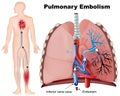 Pulmonary embolism medical illustration with description on white background