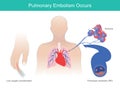 Pulmonary Embolism Occurs. Royalty Free Stock Photo