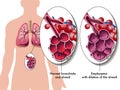 Pulmonary emphysema