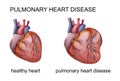 Pulmonary heart disease