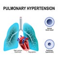 Pulmonary hypertension Royalty Free Stock Photo