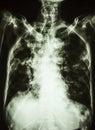 Pulmonary tuberculosis