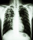 Pulmonary tuberculosis