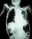 Pulmonary Tuberculosis with acute respiratory failure ( Film chest x-ray of old patient show alveolar and interstitial infiltratio Royalty Free Stock Photo