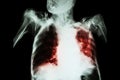 Pulmonary Tuberculosis with acute respiratory failure ( Film chest x-ray of old patient show alveolar and interstitial infiltratio Royalty Free Stock Photo