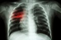 Pulmonary Tuberculosis ( Chest X-ray of child : show patchy infiltration at right middle lung ) Royalty Free Stock Photo